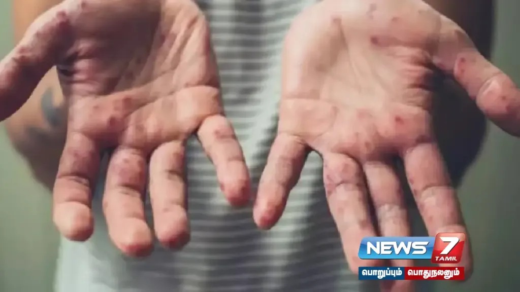 #Monkeypox | Two confirmed cases of monkeypox in Kerala!